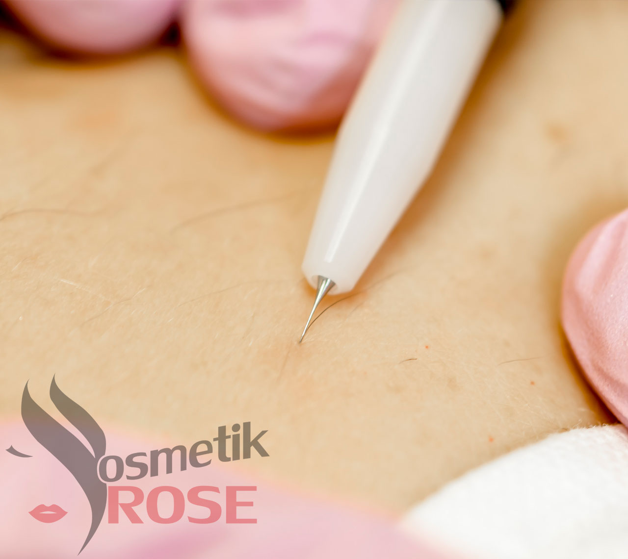 Haarentfernung mit Wachs